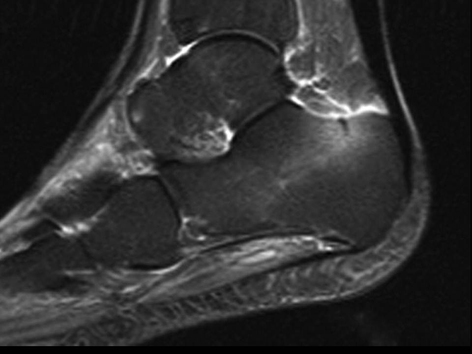 Calcaneus Fractures Trauma Orthobullets